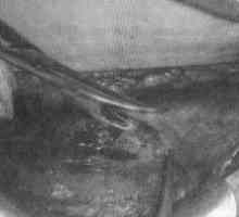 Cezariana secțiune incizie transversală în segmentul uterin inferior