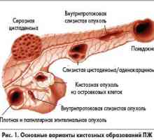 Chistul pancreasului (cap și coadă), simptomele, prognozele pentru tratamentul tumorilor, fotografii