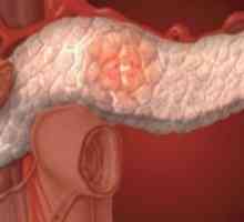 Tumorile chistice ale pancreasului