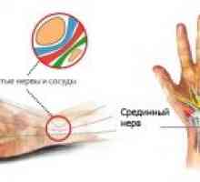 Compresia nervului ulnar la nivelul încheieturii mâinii: Tratamentul, cauze, simptome