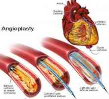 Angioplastie coronariană