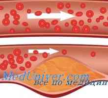 Vasele sanguine dermale diabetul zaharat. Microangiopatie la diabet