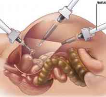 Pancreas laparoscopie în pancreatita