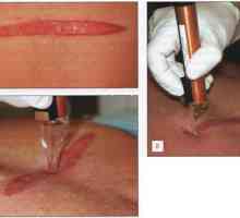 Laseri în tratamentul cicatricelor. Metode de tratament