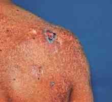 Tratamentul cicatrice cheloide la pacienții negri și alte grupuri de risc