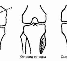 Radiații si diagnostic instrumental al genunchiului patologiei articulare. Tumora a articulației…