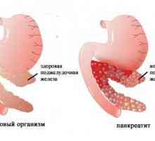 Pancreatita indusă de medicamente