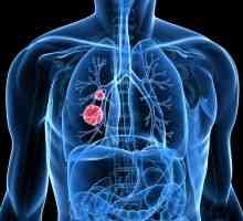 Cancer pulmonar cu celule mici: prognostic, tratament, stadiu, simptome, semne