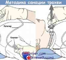 Metodă de aspirare-traheală, tub endotraheal