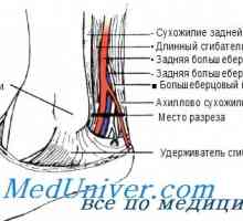 Metoda posterioara a arterei tibiale cateterizare prin izolarea