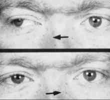 Ophthalmoplegia internucleară: simptome, tratament, simptome, cauze