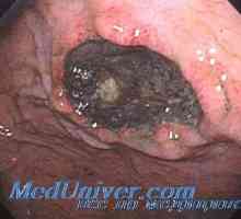 Ulcer gastric Mineralkortikoidy. ulcer aldosteronul
