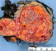 Morfologia tumori suprarenale. Androsteromy