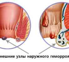 Hemoroizi externi, hemoroizi externi
