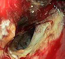 Cancerul gastric nediferențiat și prognosticul