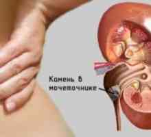 Neoplasmul în rinichi (hipernefrom)