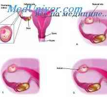 Examinarea uterului. Examinarea cavității pelviene, cu o sarcina extrauterina