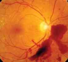 Ocluzia arterei centrale a retinei: tratament, cauze, diagnostic