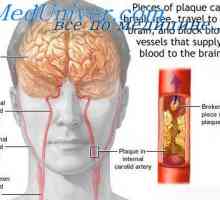 Microcirculația a creierului. Cauzele de accident vascular cerebral