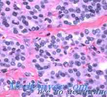 Onkotsitarnaya celule Hurthle adenom sau adenom. Postbronhialny cancer Getsov