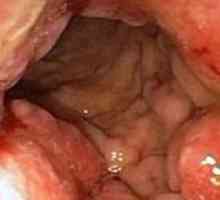 Pericol ulcer gastric împietrit