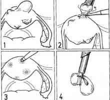 Chirurgie pe uter. miomectomie laparoscopică
