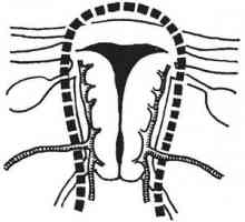 Chirurgie pe uter. histerectomia laparoscopică
