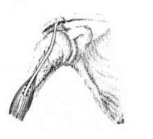 Operațiunile de la discontinuități în tendonul articulației umărului