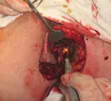 Chirurgie pentru a elimina hemoroizi si fisuri anale