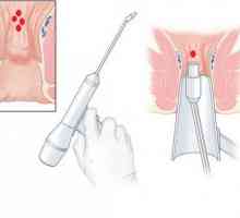 Chirurgie pentru a elimina hemoroizi cu laser Tratamentul curent al hemoroizilor