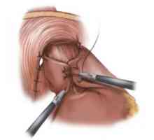 Tratamentul chirurgical al esofagita de reflux si fundoplication