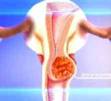 Tumoare de col uterin: simptome, tratament, cauze, simptome
