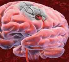 Tumoare pe creier si membranele sale, ceea ce duce la înfrângerea căii vizuale