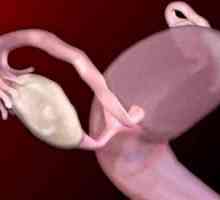 Tumori ovariene la femei benigne și maligne: simptome, tratament, simptome, cauze