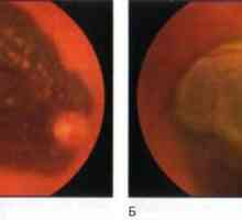 Tumorile retinei si coroida: melanomul coroidiene