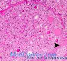 Clasificarea cancerului tiroidian. Papilar (papilar) adenocarcinom