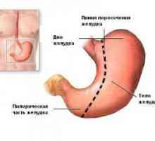 Complicațiile de rezecție gastrică și gastrectomie