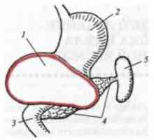 Caracteristici ale tratamentului chirurgical al chisturilor de istmul și corpul pancreasului