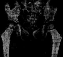 Osteoliza eroziunii osoase