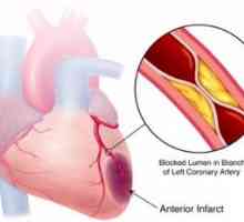 Insuficiență cardiacă coronariană acută