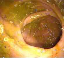 Oxiuri în intestin, anus, anus enterobioză intestinale