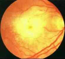 Necroza retiniană acută: simptome, tratament, cauze, simptome