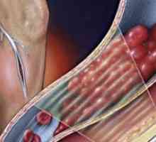 Tromboză acută a venelor profunde ale extremităților inferioare: tratament, simptome