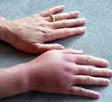 Umflarea mâinii: motivele umflate, tratament