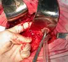 Pancreonecroza perioadă de funcționare, după o intervenție chirurgicală