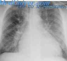 Edem pulmonar acut. Edemul pulmonar cerc vicios