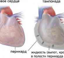Efuziune pericardică și tamponadă cardiacă