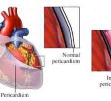 Pericardita inima: tratament, simptome, cauze, simptome
