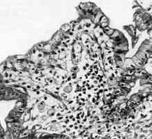 Cricoid (celule) prognosticul cancerului gastric si tratament