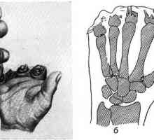 Pierderea primară și amputarea falangele degetelor și încheietura mâinii